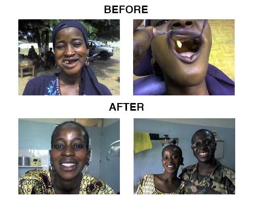 fixed-denture